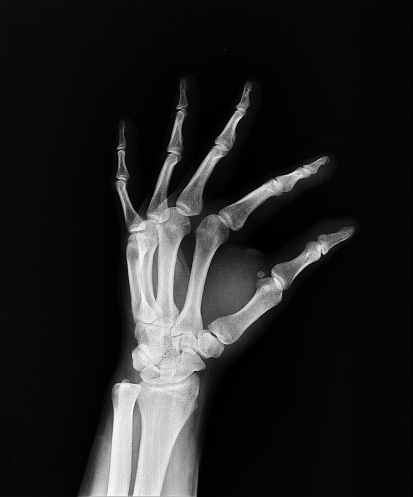 x-ray, medical treatment, arm